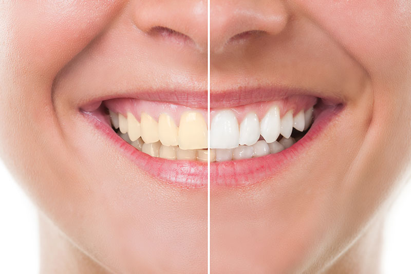 Teeth Whitening in Westminster